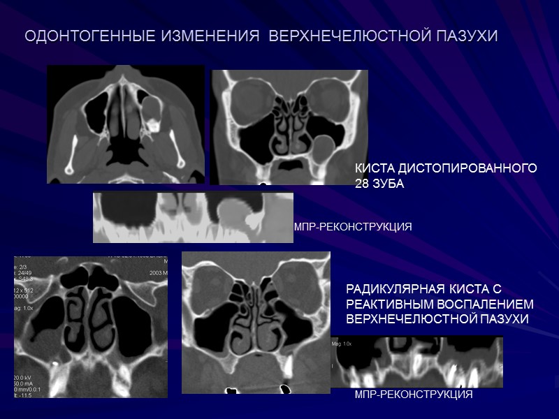 КИСТА ДИСТОПИРОВАННОГО 28 ЗУБА МПР-РЕКОНСТРУКЦИЯ ОДОНТОГЕННЫЕ ИЗМЕНЕНИЯ  ВЕРХНЕЧЕЛЮСТНОЙ ПАЗУХИ РАДИКУЛЯРНАЯ КИСТА С РЕАКТИВНЫМ